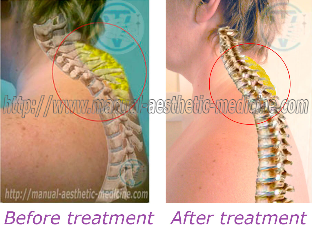 Buffalo Hump Removal Choices: Pick Atlanta's Most Effective Treatment